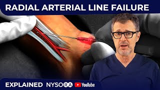 RADIAL ARTERIAL LINE FAILURE