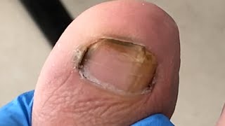 Pedicure tutorial ：A lot of black dirt【Xue Yidao】