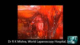 Laparoscopic Hernia Repair by Dr R K Mishra