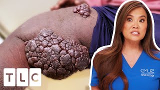 Dr. Lee Is STUMPED By Large Clustered Leg Lumps | Dr. Pimple Popper