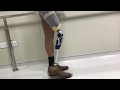 trans femoral amputee above knee amputee walking with prosthetic leg with otto bock 3r80 joint