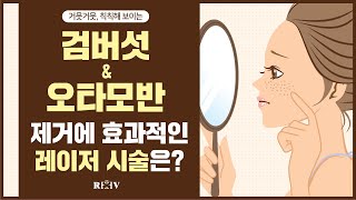 검버섯 제거 \u0026 오타모반 치료에 효과적인 레이저 추천! [광주 청담리브의원]