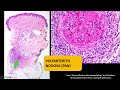 polyarteritis nodosa u0026 leukocytoclastic vasculitis pattern inflammatory dermpath basics