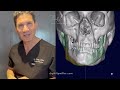 custom 3d jaw implant by dr. philip miller in nyc and nola