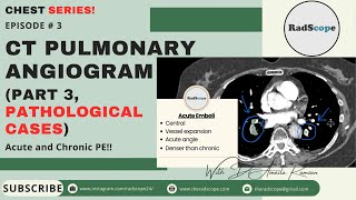 CT Pulmonary Angiogram (Part 3, Pathological Cases)