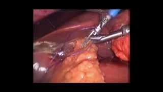 Laparascopic DU perforation Closure