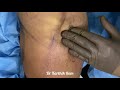 ARM SCULPTING - DR KARTHIK RAM