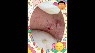 Blackheads Removal | Skincare #037 #blackheads #skincare