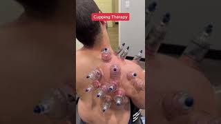 Cupping therapy #shorts #cuppingtherapy #healthtips