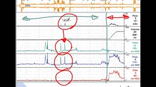 how to interpret cystometry (urodynamics)