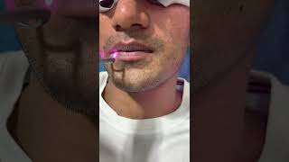 🌟 Amazing Q-Switch Laser Treatment for Dark Lips! 💄✨ |  Skinaa Clinic  #viral #ytshorts #shortsfeed