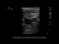 ultrasound compression test for dvt left common femoral vein normal