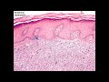 2021 Classic Lectures in Pathology: What You Need to Know: Soft Tissue Pathology - A CME Activity