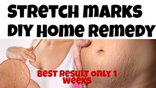 Stretch Marks Removal Diy Home Remedy /Only 1 Weeks Best Result #Beautytipsbypuja #stretchmark #2022