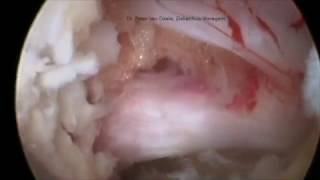 Interlaminar full-endoscopic lumbar discectomy (PTED or PELD)Dr Van Daele, Waregem, Belgium