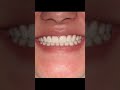 Removing White Spots | Cosmetic Dentist Dr Yazdan