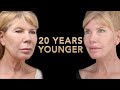 Ponytail Facelift Before and After Part 1 -  Facial Rejuvenation