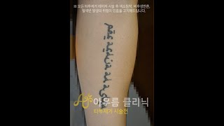 팔하완 레터링 타투제거 회차별 시술영상