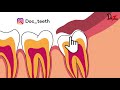 pericoronitis treatment causes u0026 symptoms