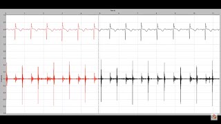 Holosystolic murmur in a child with a membranous ventricular septal defect