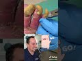 DOCTOR REACTS TO LONG FUNGUS TOENAILS!!😱 #shorts #reaction