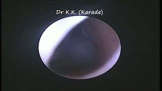 Nose Endoscopy : Septal Perforation (Hole on Septum - Middle Partition of Nasal cavity)