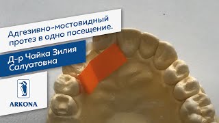 Адгезивно-мостовидный протез в одно посещение. Д-р Чайка Зилия Салуатовна