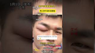 狗子叼着蜂窝给主人男人猝不及防脸被蛰网友：它放下蜂窝还知道跑