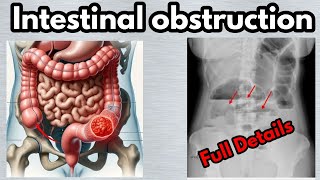 Intestinal obstruction part 2I| Intestinal obstruction symptoms,causes,diagnosis and management|