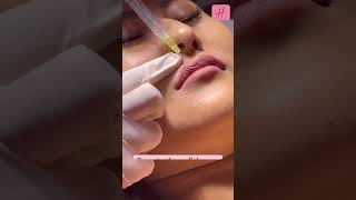💋Improved Lip Shape by Fillers Live Procedure | #shorts #shortsfeed #lipfiller