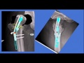 Hip fractures - Panel discussion