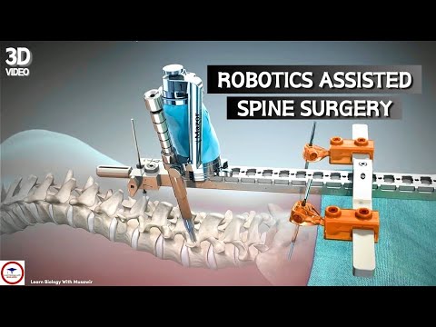 Robot Assisted Spine Surgery Animation Youtube