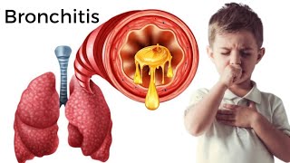 Bronquitis | Síntomas, causas y tratamiento