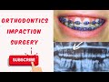 REMOVAL OF IMPACTED TEETH IN ORTHODONTIC CASE (SURGICAL EXTRACTION/ TRANSALVEOLAR EXTRACTION )