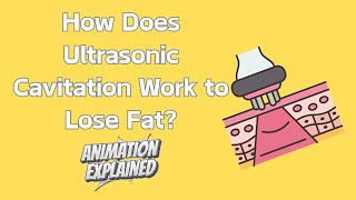 How Does Ultrasonic Cavitation Work to Remove Fat?