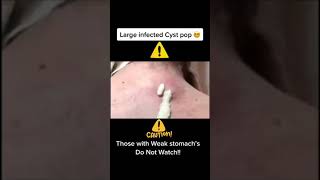 LARGE CARBUNCLE CYST REMOVAL