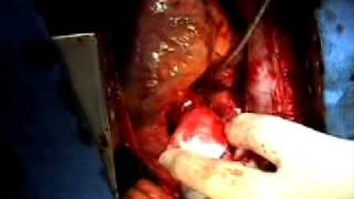 Aortic Dissection