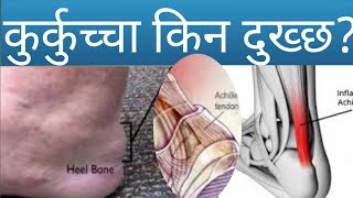 कुर्कुच्चा किन दुख्छ|Heel pain in Nepali|Dr Bhupendra Shah