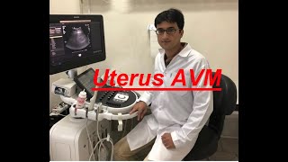 Sonography/Uterus arteriovenous malformation