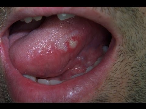 Home remedies for sore tounge Home remedies for sore tounge