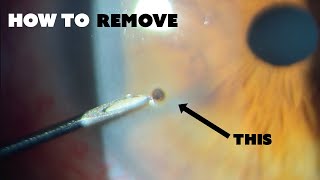 How to remove a METAL FOREIGN BODY from the cornea