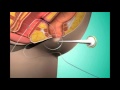 Fistula Treatment In Pune Fistula Hospital In Pune Dr Ashwin Porwal Fistula Surgeon Pune