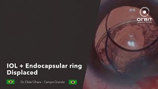 Orbit Tips 068 - IOL + Endocapsular ring Elder