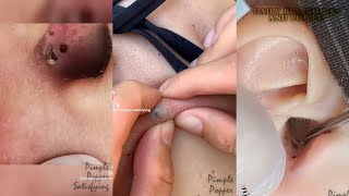 ASMR Blackhead and Acne Extraction | TikTok Compilation 2022