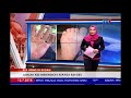 KES HFMD DI KEDAH - JUMLAH KES MENINGKAT KEPADA 834 KES [12 JULAI 2018]