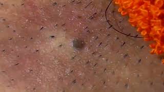 Blackheads & Milia, Big cystic acne blackheads extraction whiteheads Removal Pimple Popping