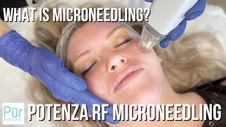 What is Microneedling? | Potenza RF Microneedling in Edmonds, WA | PUR Skin Clinic