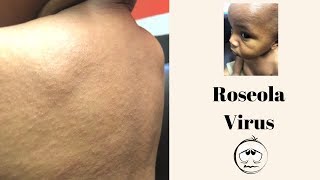 Roseola| Baby update