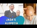 Will Smith defends jada pinkett smith and her alopecia areata diagnosis