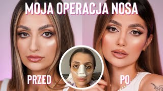 MOJA OPERACJA NOSA | Natalia Trojan